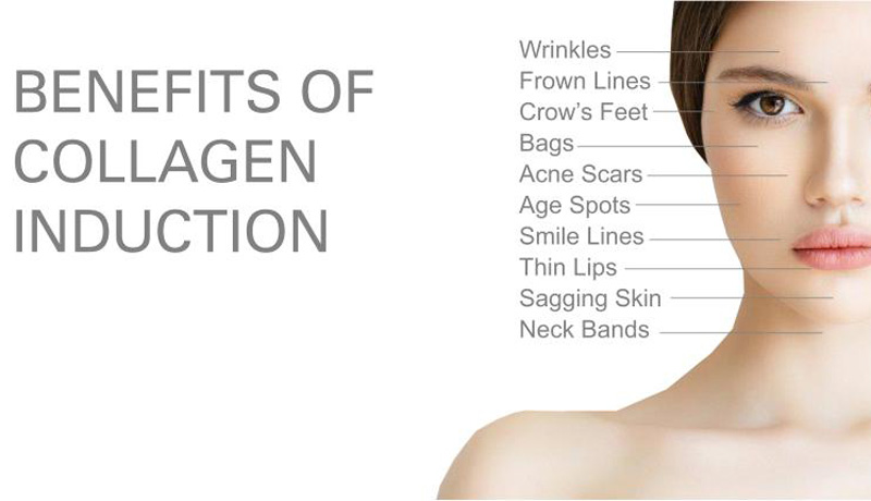 Collagen Induction Treatment