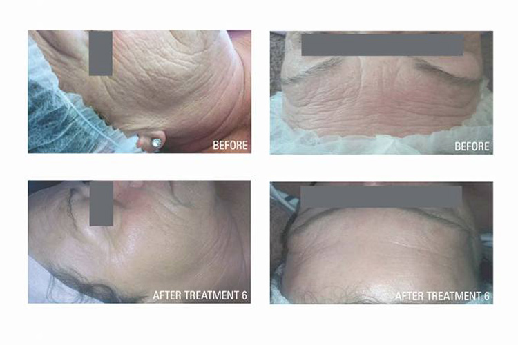 Collagen Induction Treatment