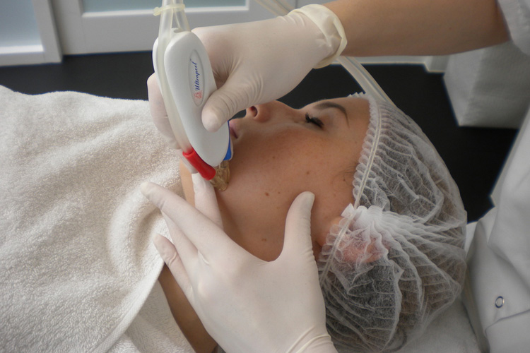 Ultrapeel II Microdermabrasion